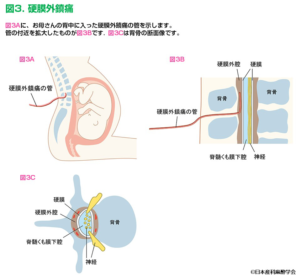 硬膜外鎮痛（出典日本産科麻酔学会）