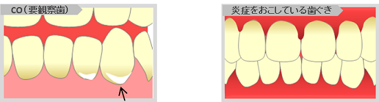 CO（観察が必要な歯）と炎症をおこしている歯ぐきのイラスト