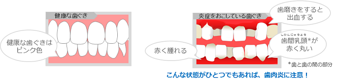 健康な歯ぐきと炎症をおこしている歯ぐきの比較イラスト