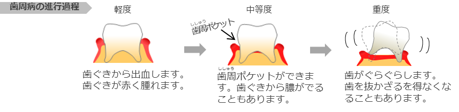 歯周病の進行過程のイラスト