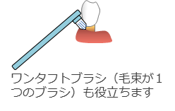 ワンタフトブラシ（毛束が1つのブラシ）も役立ちます